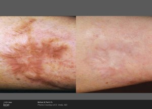 Orlando Acne and Surgical Scar Treatment Before & After - Gentle Touch