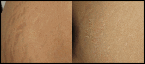 Orlando Strech Marks Before & After - Gentle Touch