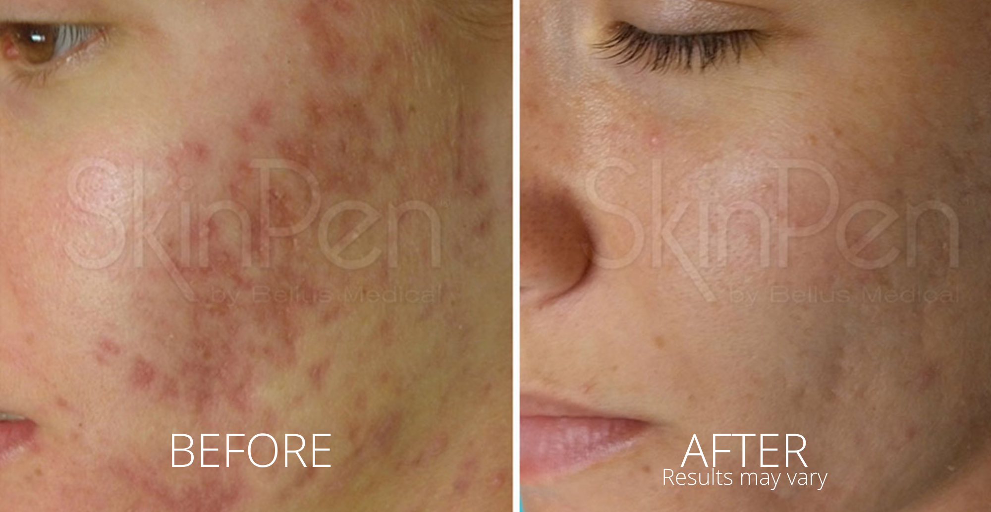 Microneedling Skinpen Acne Gentle Touch Medispa